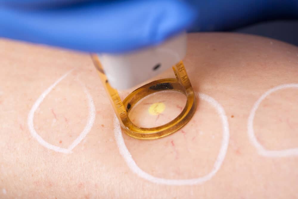 This image highlights the remarkable results of using the Candela GentleMax Pro Plus laser to treat thread veins.