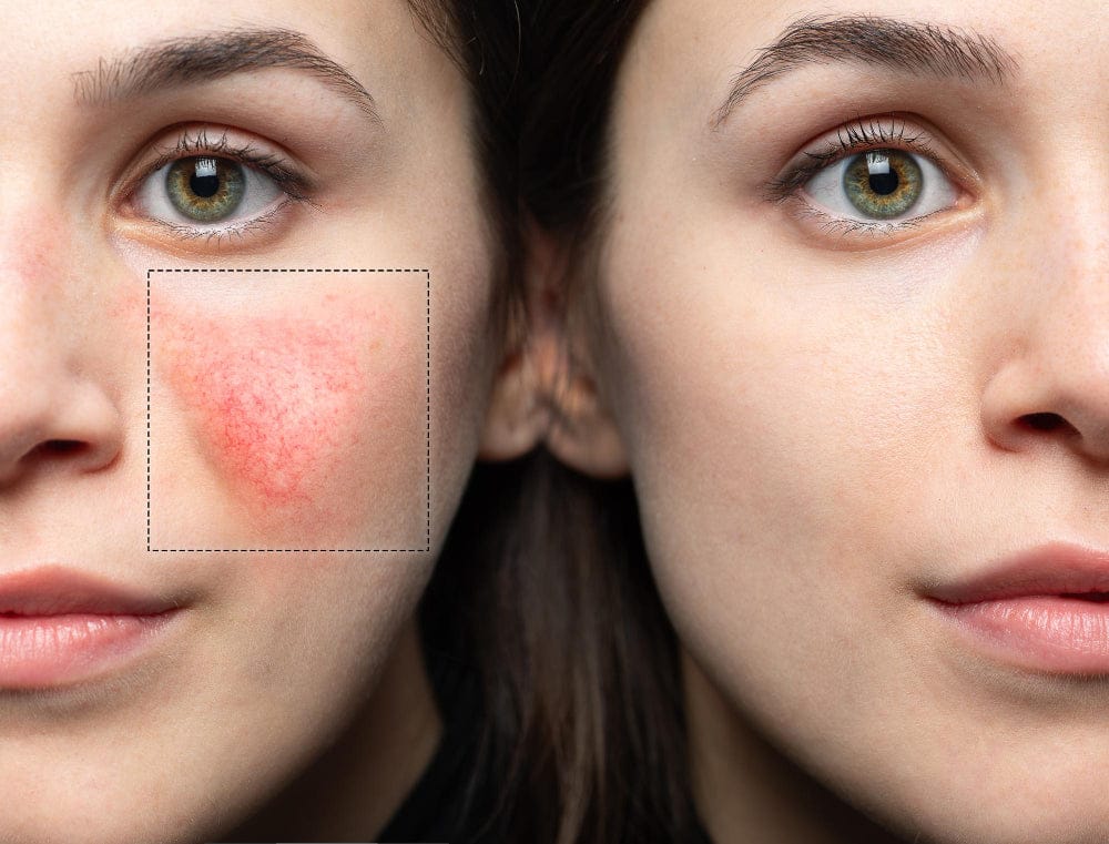 Before and After Success: Beautiful Girl Transformed with Candela GentleMax Pro Plus Rosacea Treatment!