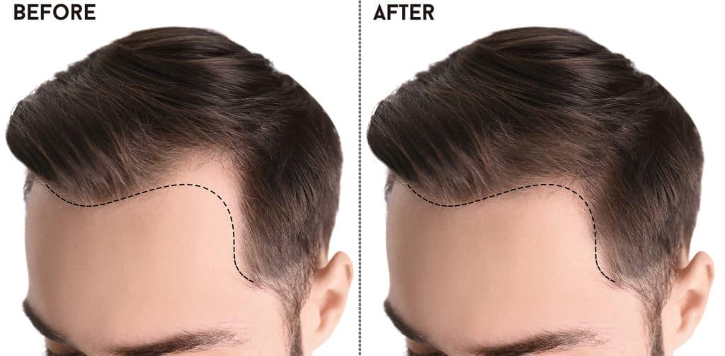 PRP Hair Treatment for Men in Bournemouth: A Natural Alternative to Hair Transplants