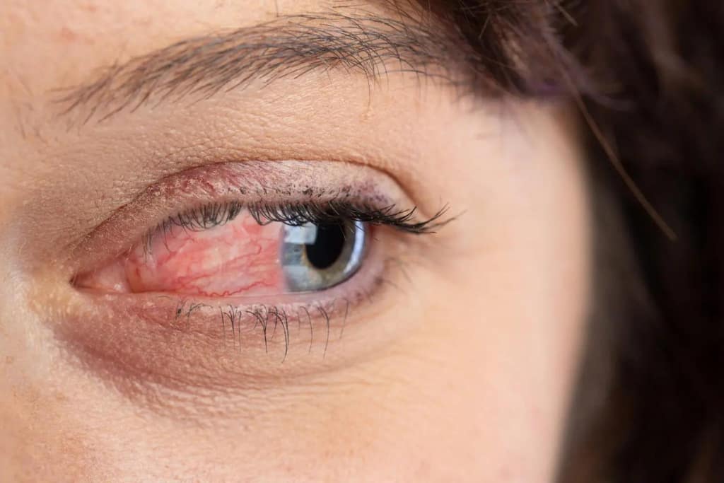Ocular Rosacea: Symptoms, Causes, and Treatment