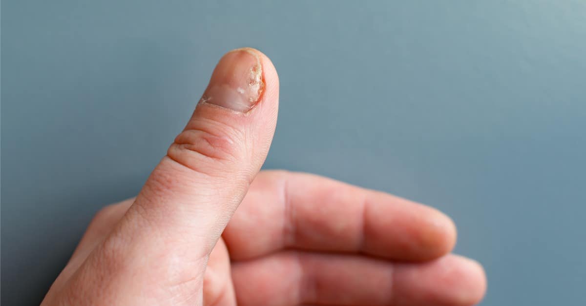 Understanding and Treating Fungal Nail Infections