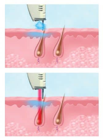 Discover the advanced cooling technology of the GentleMax Pro Plus laser in our image, showcasing the mechanism of action of the cryogen spray.