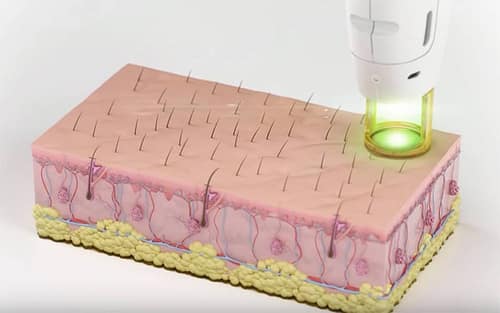 The laser beam from the device targets hair on the skin's surface, delivering precise energy to the hair follicle.