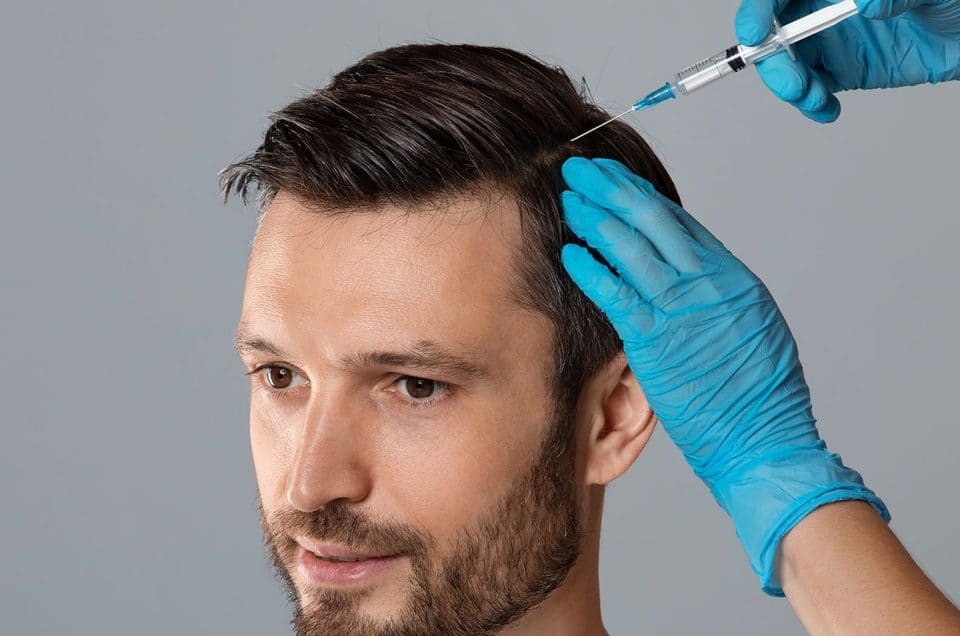 The Benefits of PRP Microneedling for Hair Loss