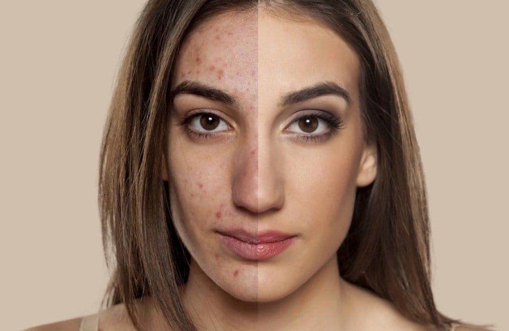 Before and After Treatment: See the Freckles Clear with Candela GentleMax Pro Plus Laser! Witness the effectiveness of advanced laser technology in targeting and reducing freckles.