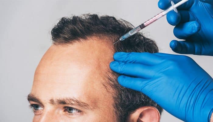 A man undergoing PRP treatment for hair loss at Progen Aesthetics in Bournemouth.